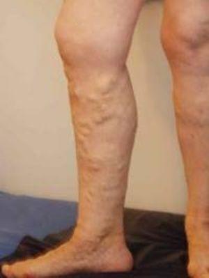 picioarele mezoterapiei în varicoza)