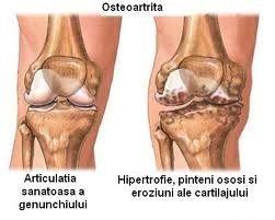 Osteoartrita genunchiului și tocurilor