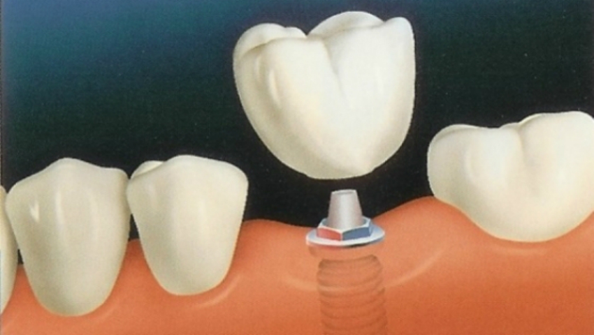 Tot Ce Trebuie S Tii Despre Un Implant Dentar Unica Md