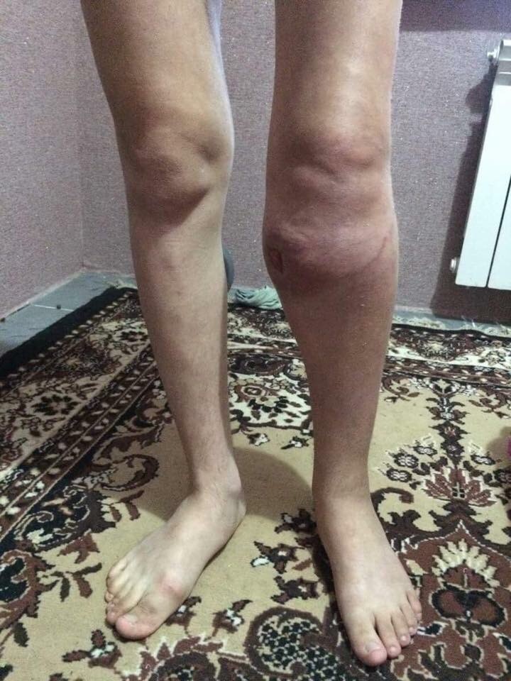 picioarele tumorale dupa exploatarea operaiunilor)