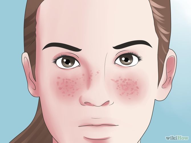 Lupus Facial Rash