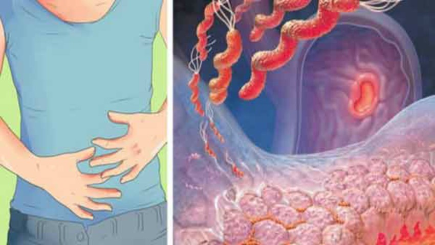 Infecția cu Helicobacter Pylori - cauze și manifestări Pierdere în greutate e coli