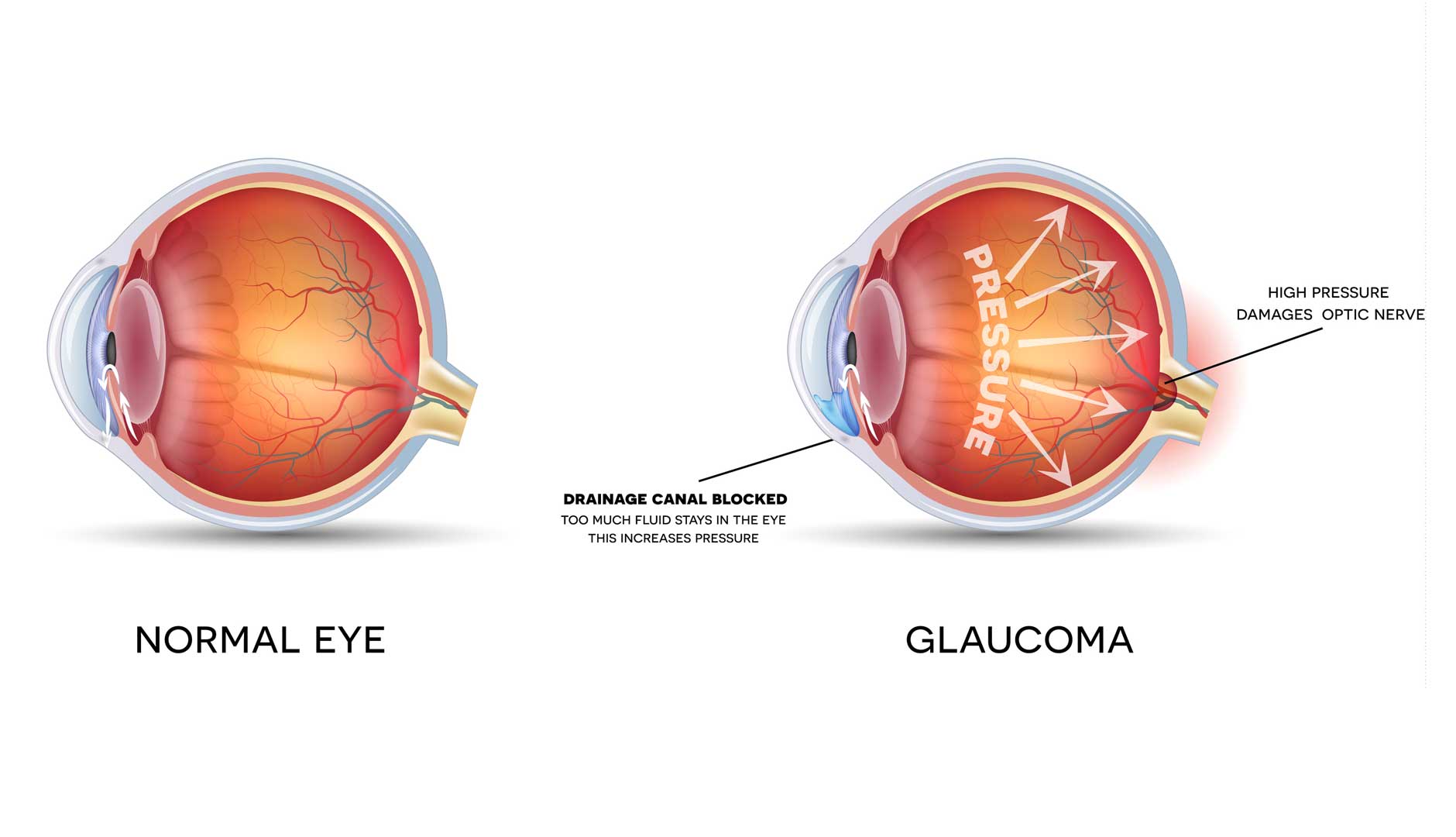 boală oculară glaucom